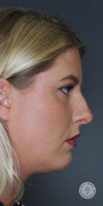 other side profile of woman before fillers