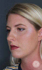 profile of woman with nose ring before fillers