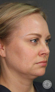 close up of caucasian woman's face side view before kybella