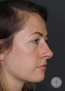 side profile of woman before restylane