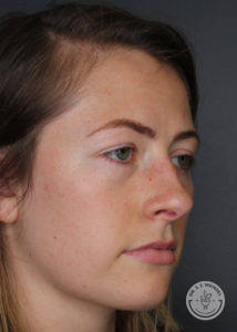 Side image of woman before restylane