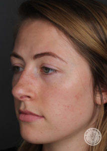 Side image of woman before restylane
