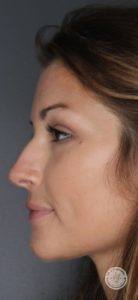 close up of woman's face before voluma treatment side view
