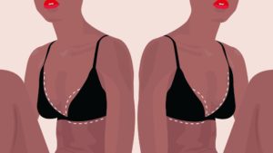 breast reduction graphic of woman in bra
