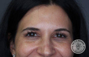 close-up of brunette woman's forehead after botox