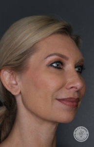 after liquid facelift woman smiling to side