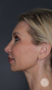 after liquid facelift profile straight face