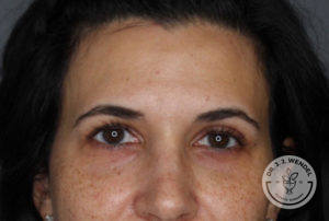 Close-up of woman's forehead before botox