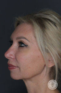 before liquid facelift profile straight face