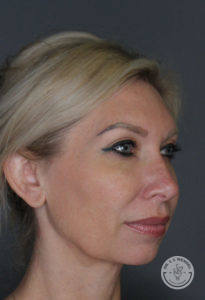 before liquid facelift profile woman not smiling