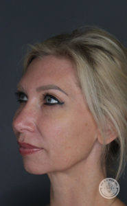 before liquid facelift profile woman smiling