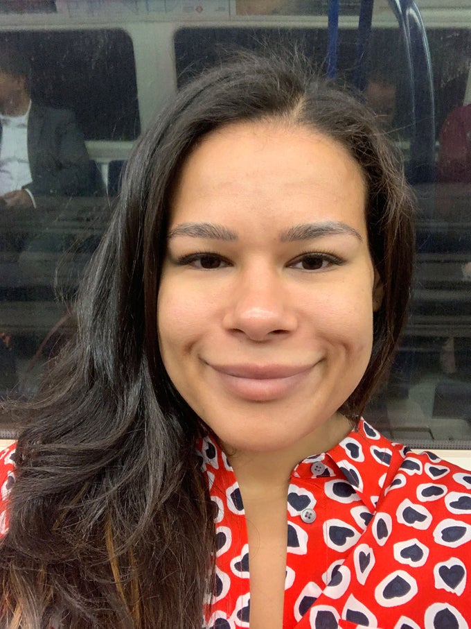 woman taking selfie after acne scar treatment