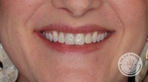 Woman's smile after botox