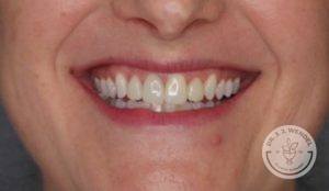 Woman's smile before botox