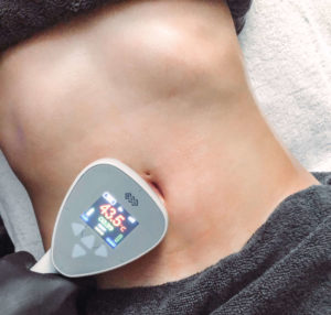 Woman receiving Exilis treatment