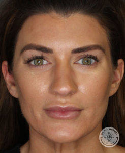 front view of woman who received jawline filler