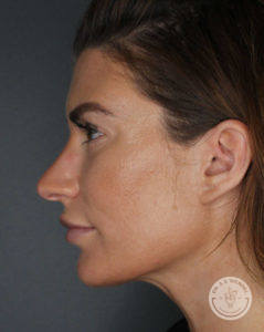 side left profile of woman after she received jawline filler