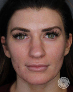 front view of brunette woman before receiving jawline filler