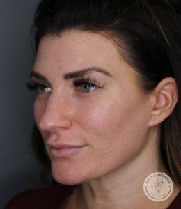 side angle of brunette woman before receiving jawline filler