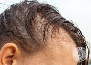 person with thinning hair starting to bald