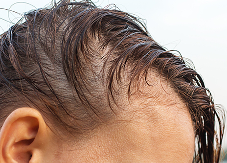 person with thinning hair starting to bald