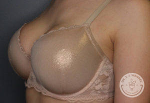 close up photo of woman in bra after kybella treatment