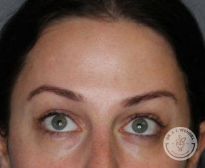 Forehead of a caucasian woman with green eyes after botox