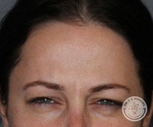 close up of white woman's upper face after botox treatment