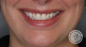 close up of white woman's lips smiling after botox treatment