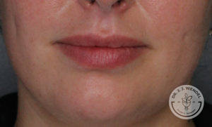 close up of white woman's lips after botox treatment