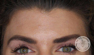 close up of white brunette woman's forehead after dysport treatment