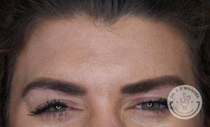 close up of white brunette woman's forehead after dysport treatment