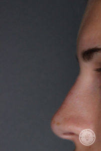 close up side view of caucasian woman's nose after liquid rhinoplasty
