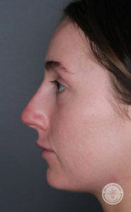 close up side view of caucasian woman's face after liquid rhinoplasty