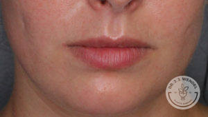 close up of a caucasian woman's lips before botox treatment