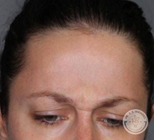 Forehead of a caucasian woman with green eyes before botox