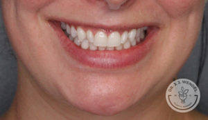 close up of white woman's lips smiling before botox treatment