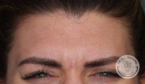 close up of white brunette woman's forehead before dysport treatment