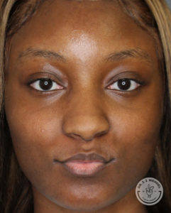 Close-up of a black woman before juvederm treatment