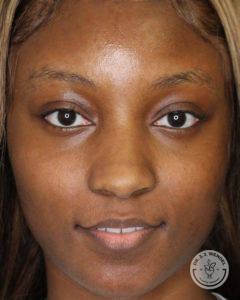 Close-up of a black woman before juvederm treatment