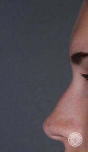 close up side view of caucasian woman's nose before liquid rhinoplasty