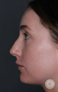 close up side view of caucasian woman's face before liquid rhinoplasty