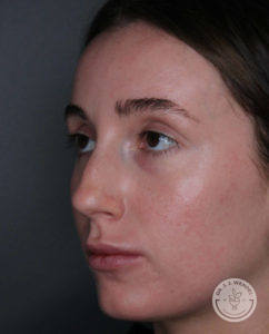 close up side view of caucasian woman's face before liquid rhinoplasty