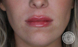 close up of white woman's lips after lip filler