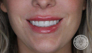 close up of white woman's lips smiling after juvederm lip filler