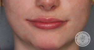 close up of woman's lips after juvederm treatment