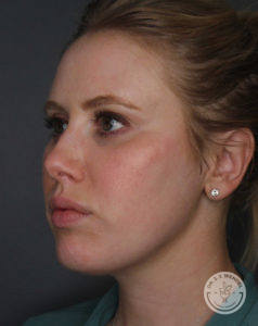 side profile of white blonde after kybella treatment