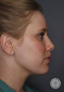 side profile of white blonde after kybella treatment