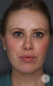 Close-up of blonde woman's face after Kybella