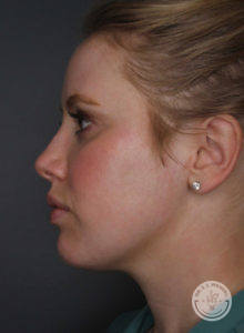 Side profile of blonde woman's face after Kybella treatment